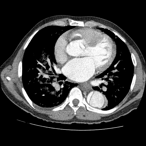 File:Aortic dissection - Stanford A -DeBakey I (Radiopaedia 28339-28587 B 55).jpg