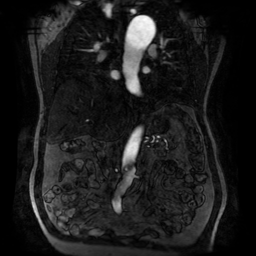 Aortic dissection - Stanford A - DeBakey I (Radiopaedia 23469-23551 D 121).jpg