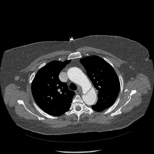 File:Aortic dissection - Stanford type B (Radiopaedia 88281-104910 A 19).jpg