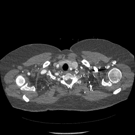 Aortic dissection - Stanford type B (Radiopaedia 88281-104910 A 2).jpg