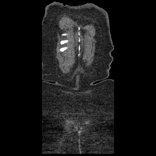 File:Aortic dissection - Stanford type B (Radiopaedia 88281-104910 B 92).jpg