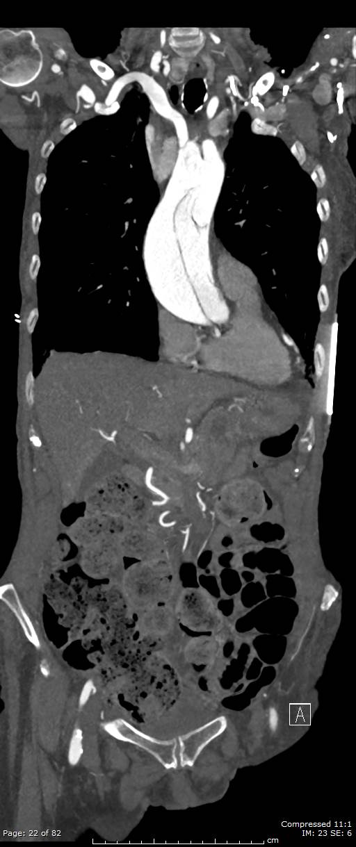 Aortic dissection with extension into aortic arch branches (Radiopaedia 64402-73204 A 22).jpg