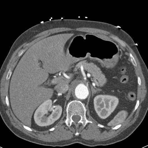 Aortic intramural hematoma (Radiopaedia 31139-31838 B 88).jpg