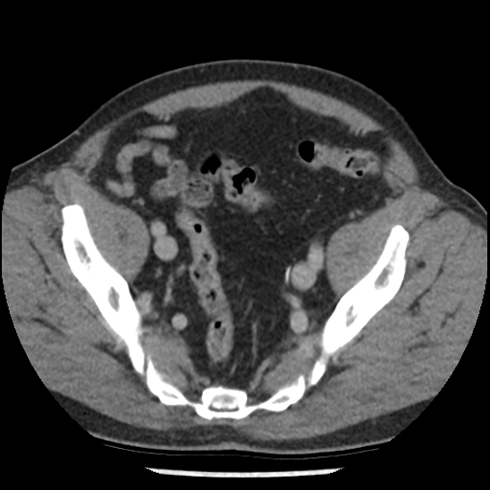 Aortic intramural hematoma (type B) (Radiopaedia 79323-92387 Axial C+ delayed 100).jpg