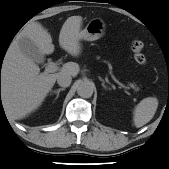 File:Aortic intramural hematoma (type B) (Radiopaedia 79323-92387 Axial non-contrast 56).jpg