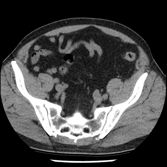 Aortic intramural hematoma (type B) (Radiopaedia 79323-92387 Axial non-contrast 96).jpg