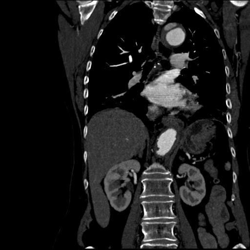 File:Aortic intramural hematoma from penetrating atherosclerotic ulcer (Radiopaedia 31137-31836 C 38).jpg