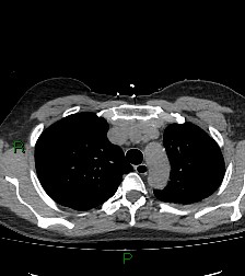 Aortic valve endocarditis (Radiopaedia 87209-103485 Axial non-contrast 28).jpg