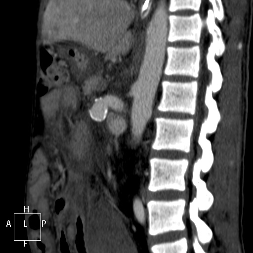 Aorto-left renal vein fistula (Radiopaedia 45534-49628 C 38).jpg