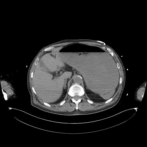 Aortoduodenal fistula (Radiopaedia 75286-86415 Axial non-contrast 13).jpg