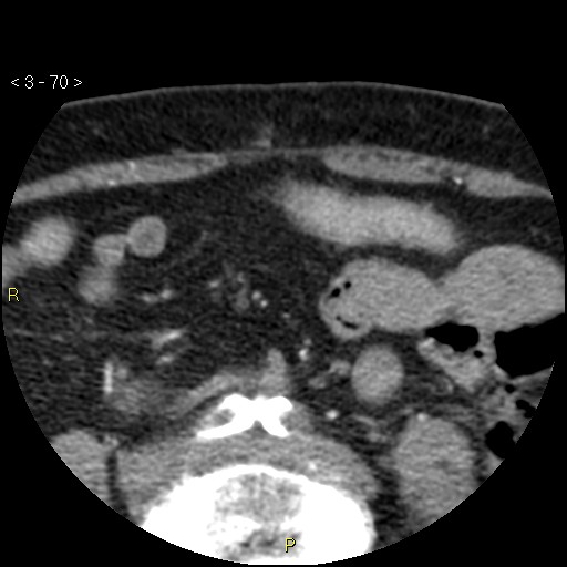 Aortoiliac occlusive disease (Radiopaedia 16828-16548 A 70).jpg