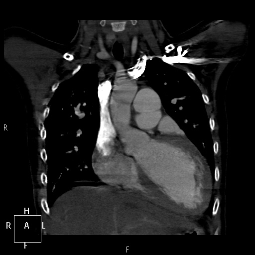 File:Aortopulmonary septal defect (Radiopaedia 41990-45013 Coronal C+ CTPA 20).jpg