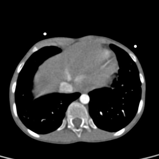 File:Aortopulmonary window, interrupted aortic arch and large PDA giving the descending aorta (Radiopaedia 35573-37074 B 78).jpg