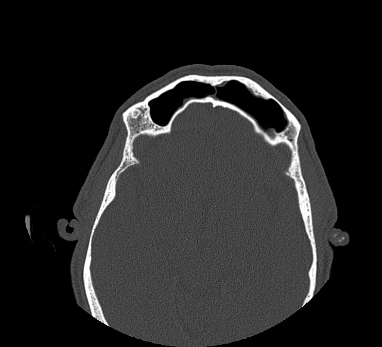 Aplastic maxillary sinuses (Radiopaedia 60030-67561 Axial non-contrast 59).jpg
