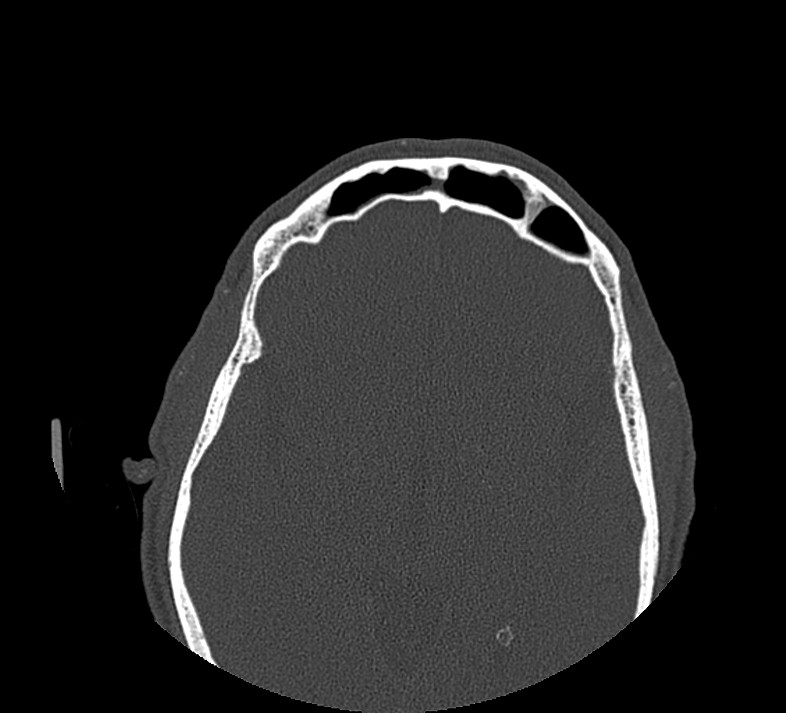 Aplastic maxillary sinuses (Radiopaedia 60030-67561 Axial non-contrast 65).jpg