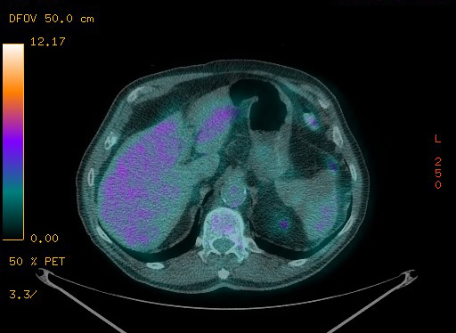 Appendiceal adenocarcinoma complicated by retroperitoneal abscess (Radiopaedia 58007-65041 Axial PET-CT 105).jpg