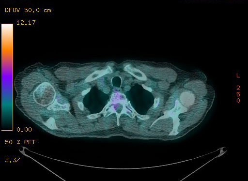 Appendiceal adenocarcinoma complicated by retroperitoneal abscess (Radiopaedia 58007-65041 Axial PET-CT 35).jpg