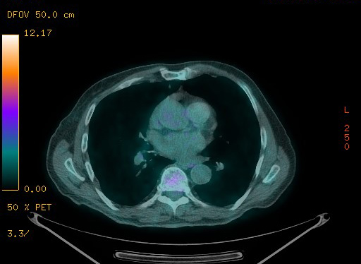 Appendiceal adenocarcinoma complicated by retroperitoneal abscess (Radiopaedia 58007-65041 Axial PET-CT 73).jpg