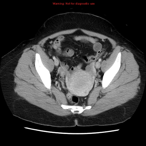 Appendiceal mucinous cystadenoma (Radiopaedia 8263-9111 Axial liver window 68).jpg