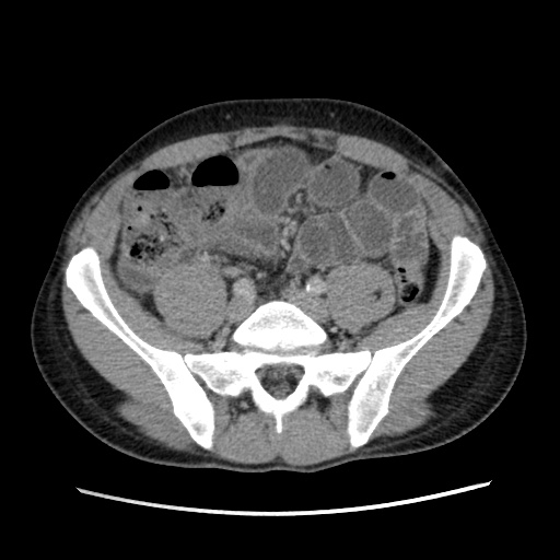 File:Appendicitis complicated by post-operative collection (Radiopaedia 35595-37114 A 60).jpg
