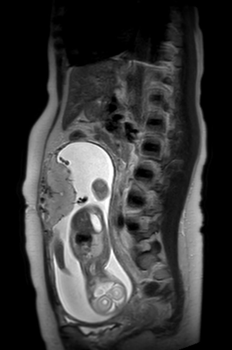 Appendicitis in gravida (MRI) (Radiopaedia 89433-106395 Sagittal T2 29).jpg