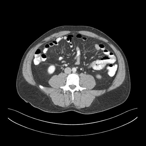 File:Appendicitis with cecal bar sign (Radiopaedia 31878-32830 A 1).jpg