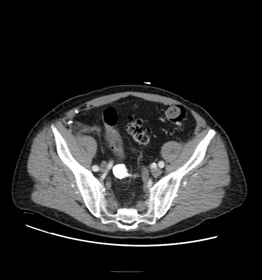 Appendicitis with localized perforation and abscess formation (Radiopaedia 49035-54130 A 70).jpg