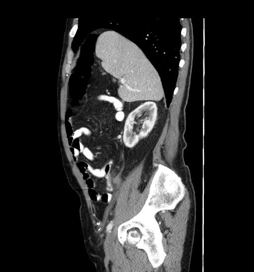 Appendicitis with localized perforation and abscess formation (Radiopaedia 49035-54130 C 19).jpg