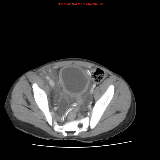 File:Appendicitis with phlegmon (Radiopaedia 9358-10046 A 59).jpg