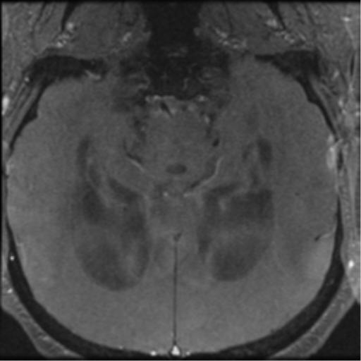 Aqueduct stenosis with corpus callosum hypoattenuation post shunting (Radiopaedia 37212-38969 Axial CSF Flow 38).png