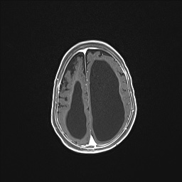 Aqueductal stenosis (Radiopaedia 73974-84802 Axial T1 C+ 118).jpg