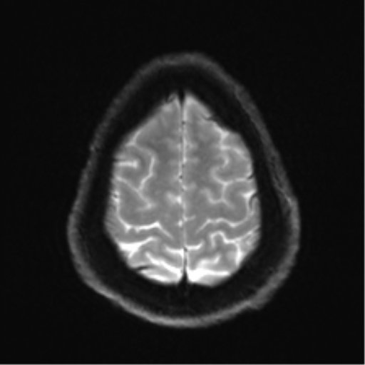Arachnoid cyst - cerebellopontine angle (Radiopaedia 59689-67083 Axial DWI 31).png