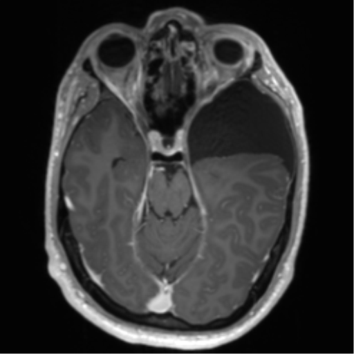 Arachnoid cyst with subdural hematoma (Radiopaedia 85892-101743 Axial T1 C+ 34).png