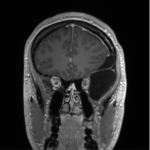 Arachnoid cyst with subdural hematoma (Radiopaedia 85892-101743 Coronal T1 C+ 69).png