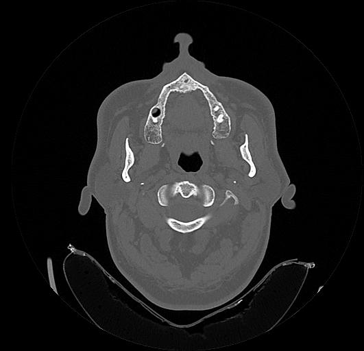Arcuate foramen (Radiopaedia 89833-106944 Axial bone window 37).jpg