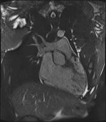 File:Arrhythmogenic right ventricular cardiomyopathy (Radiopaedia 57972-64966 CINE R2 SSFP 12).jpg