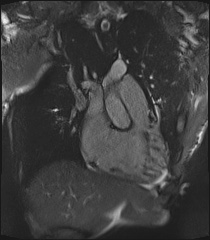 Arrhythmogenic right ventricular cardiomyopathy (Radiopaedia 57972-64966 CINE R2 SSFP 50).jpg