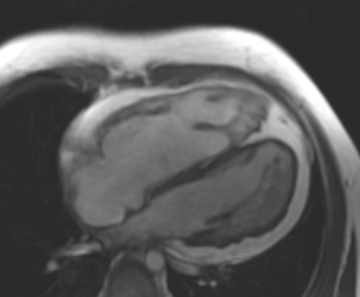 Arrhythmogenic right ventricular cardiomyopathy (Radiopaedia 69431-79307 4ch cine 37).jpg