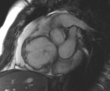 Arrhythmogenic right ventricular cardiomyopathy (Radiopaedia 69431-79307 Short axis cine 204).jpg