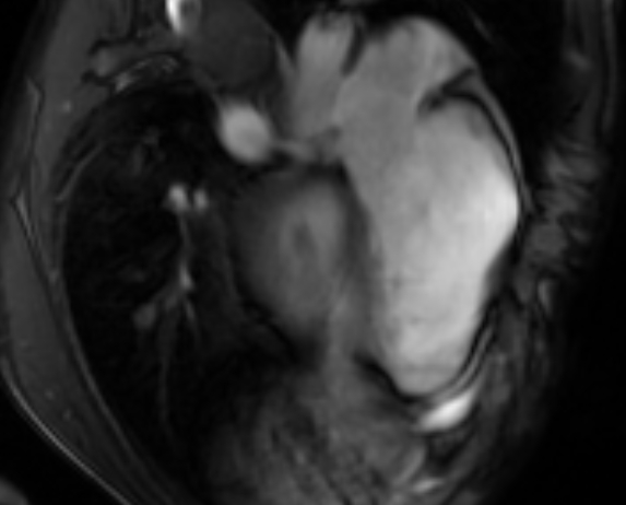 File:Arrhythmogenic right ventricular cardiomyopathy (Radiopaedia 69564-79464 4ch cine 104).jpg