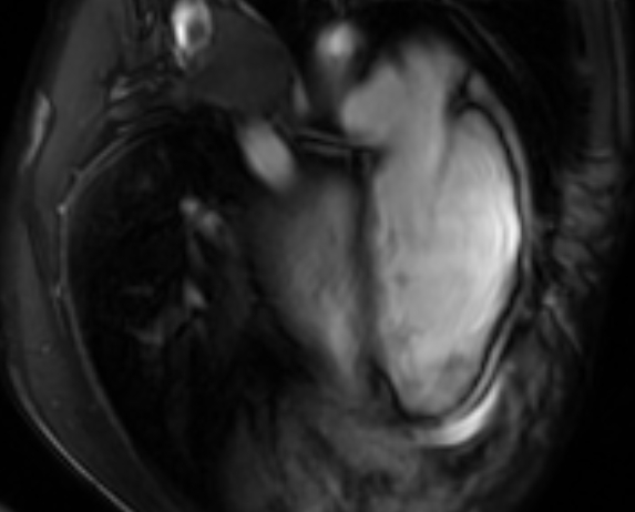 Arrhythmogenic right ventricular cardiomyopathy (Radiopaedia 69564-79464 4ch cine 136).jpg