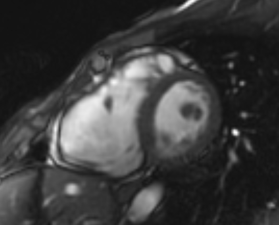 File:Arrhythmogenic right ventricular cardiomyopathy (Radiopaedia 69564-79464 short axis cine 149).jpg