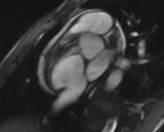 Arrhythmogenic right ventricular cardiomyopathy (Radiopaedia 69564-79464 short axis cine 271).jpg