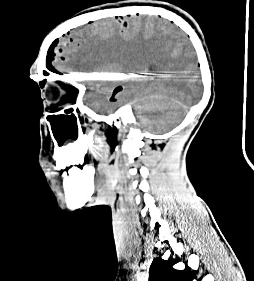Arrow injury to the brain (Radiopaedia 72101-82607 H 42).jpg