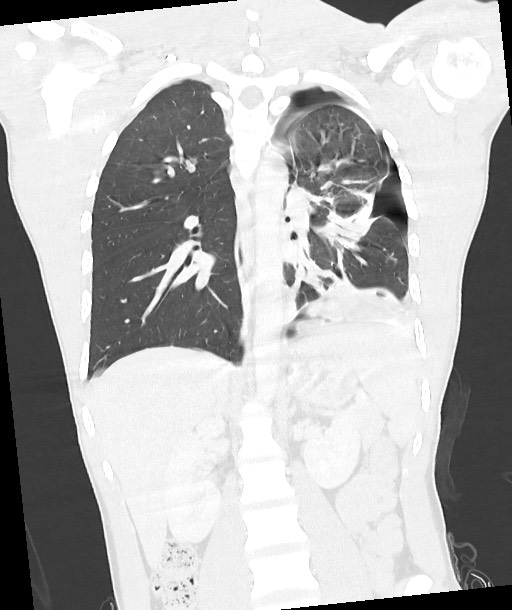 Arrow injury to the chest (Radiopaedia 85367-100975 Coronal lung window 86).jpg