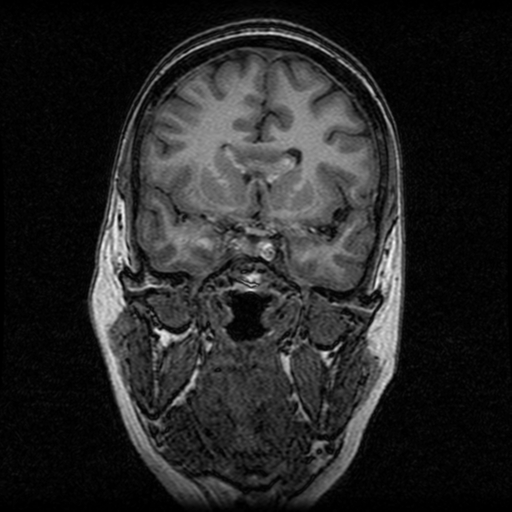Arteriovenous malformation (cerebral) (Radiopaedia 40070-42580 Coronal T1 39).png