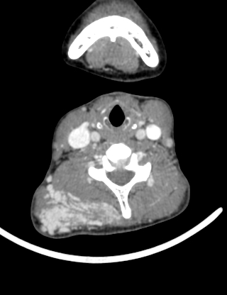 File:Arteriovenous malformation of the neck (Radiopaedia 53935-60062 B 29).jpg