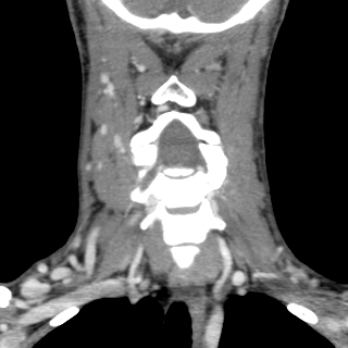 Arteriovenous malformation of the neck (Radiopaedia 53935-60062 D 16).jpg