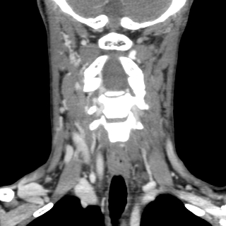 File:Arteriovenous malformation of the neck (Radiopaedia 53935-60062 D 9).jpg