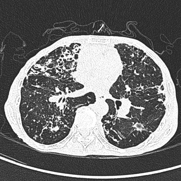 File:Aspergilloma- with Monod sign (Radiopaedia 44737-48532 Axial lung window 143).jpg